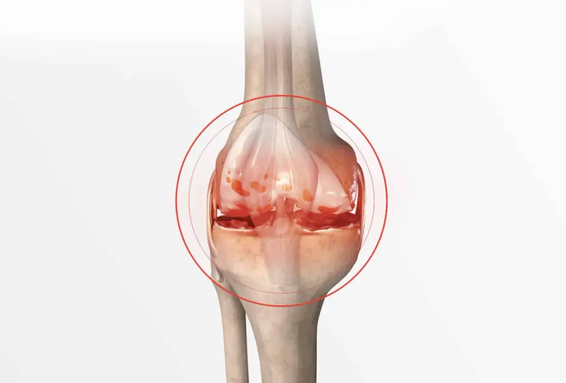 Illustration d'un genou montrant les symptômes d'une crise d'arthrose : cartilage usé et inflammation.