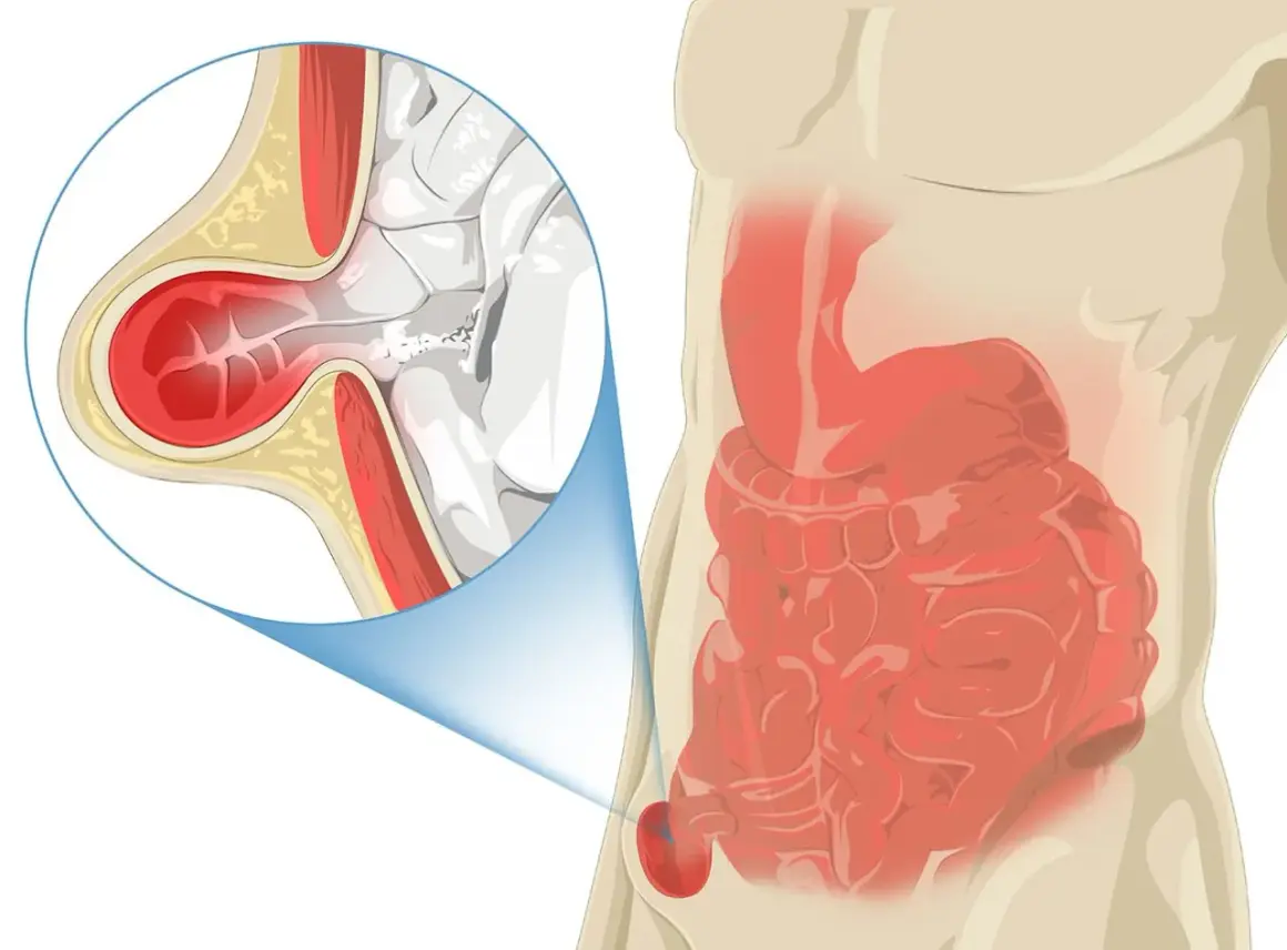 Illustration d'une hernie inguinale, montrant l'intestin sortant par une faiblesse de la paroi abdominale. Le pubis gonflé est une cause de douleur.