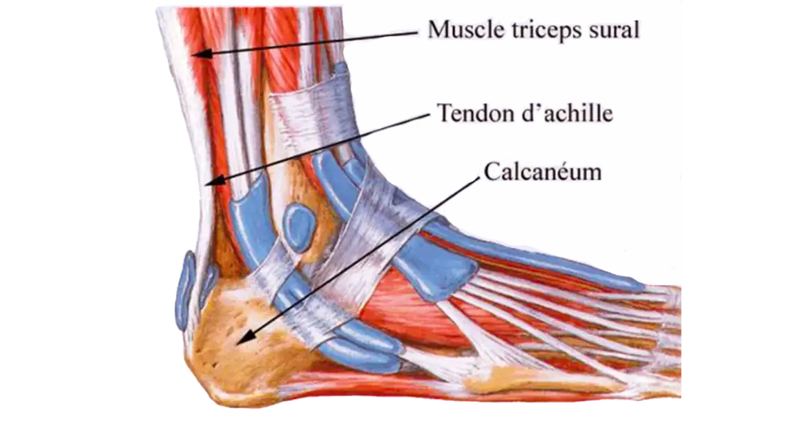 Anatomie du pied montrant le muscle triceps sural, le tendon d'Achille et le calcanéum. Illustration d'une tendinite du tendon d'Achille.