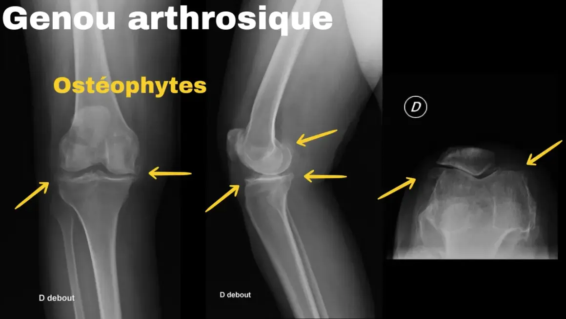 Radiographies du genou montrant un arthrose genou stade 4 avec ostéophytes marqués, rétrécissement de l'espace articulaire et déformations osseuses.