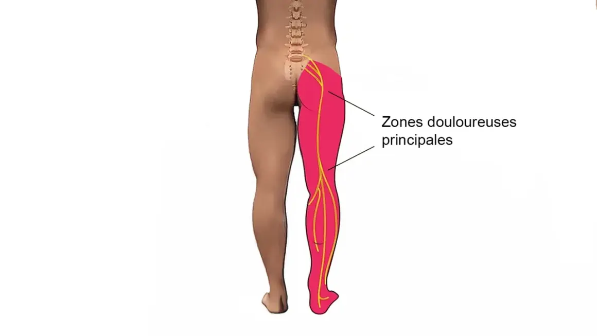 Douleur irradiant de la fesse, le long de la cuisse, jusqu'au pied. Zones douloureuses principales.