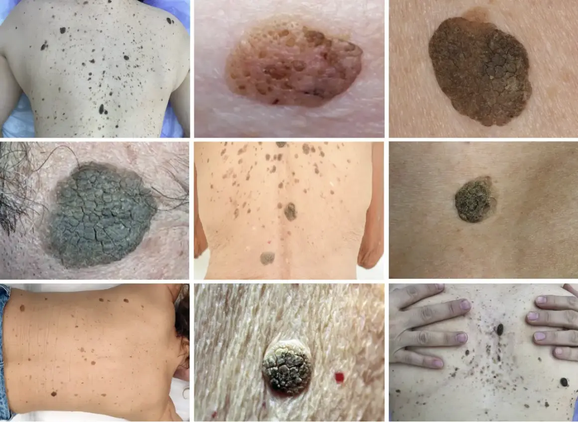 Diverses lésions cutanées, dont des kératoses séborrhéiques. Recherche d'un traitement naturel pour ces affections.