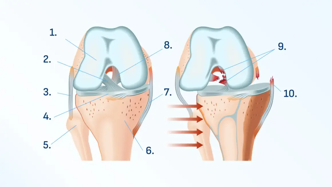 Illustration du genou montrant une déchirure ligamentaire interne. Aide à comprendre comment soigner douleur genou interne.