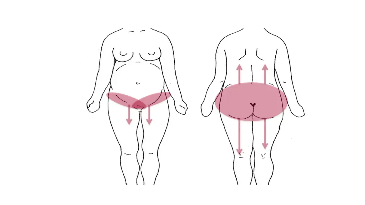 Schéma montrant les zones de douleur pelvienne chez la femme, avec des flèches indiquant la direction de la douleur.