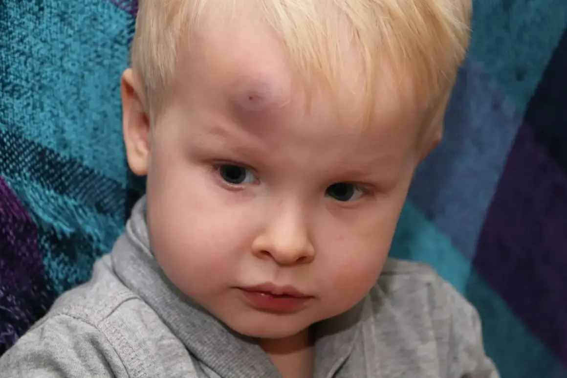 Petit garçon avec un hématome boule dure sur le front, résultat d'une chute.