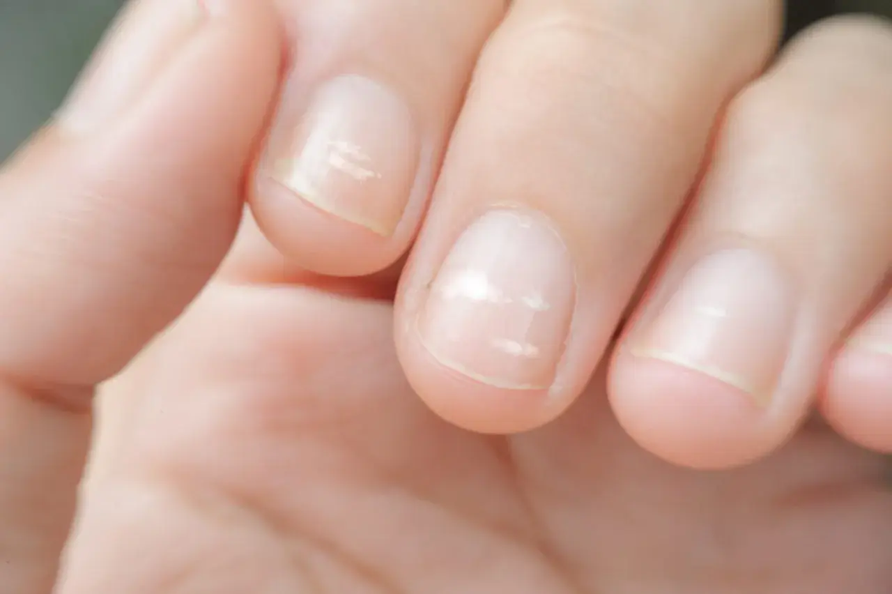 Plusieurs ongles présentent une tache blanche, comme des nuages dans le ciel, indiquant une possible carence.