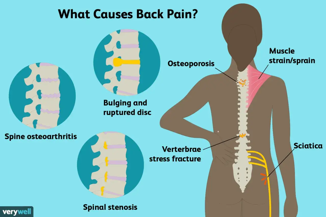 Illustration des causes de la douleur dos droite : hernie discale, arthrose, ostéoporose, sciatique, etc.