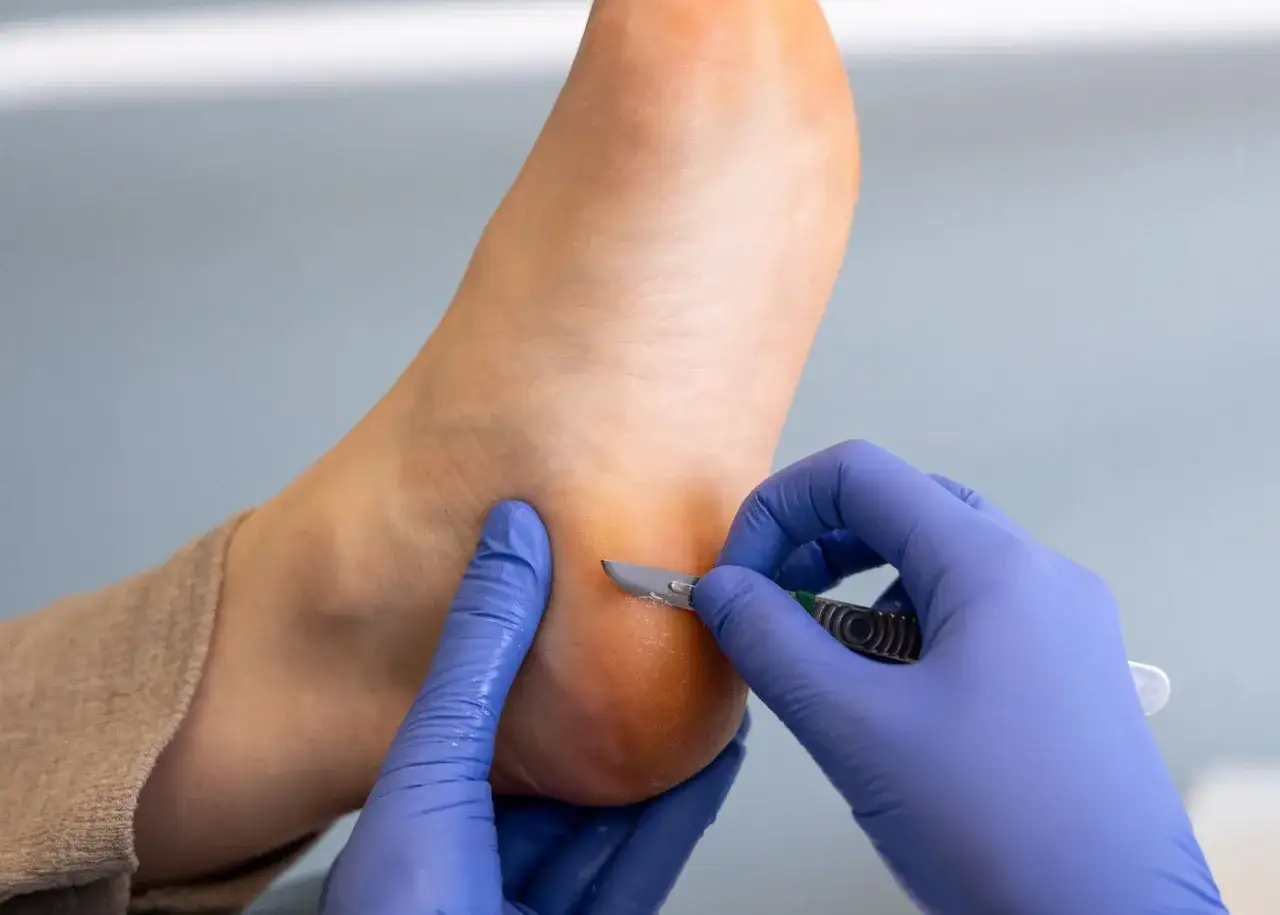 Un podologue utilise un scalpel pour retirer une corne au pied, un remède miracle pour retrouver des pieds doux.