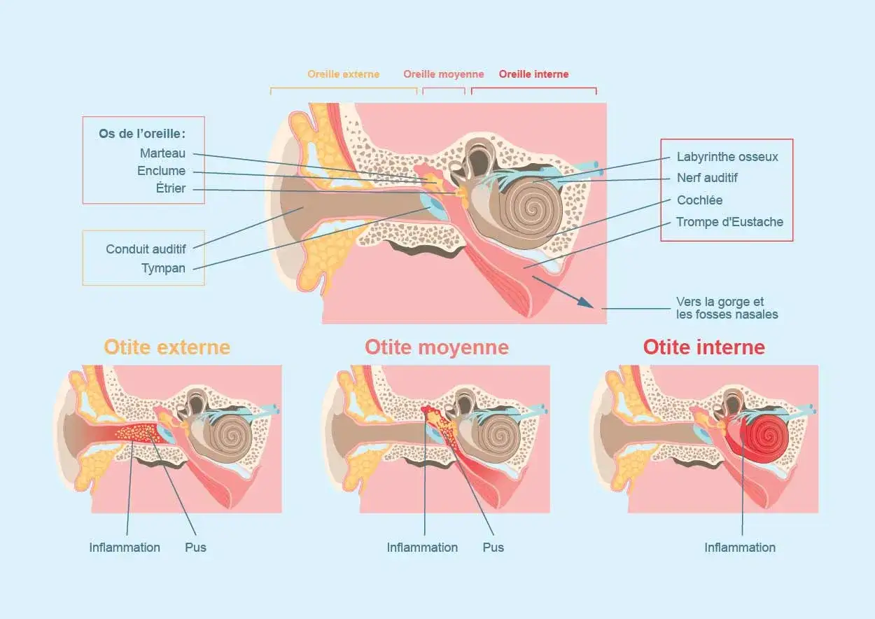 Schéma de l'oreille montrant otite externe, moyenne et interne. Des remèdes naturels peuvent aider à soulager l'inflammation.