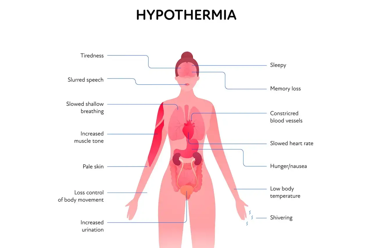 Illustration des symptômes de l'hypothermie : frissons sans fièvre, fatigue, confusion, ralentissement des fonctions vitales.