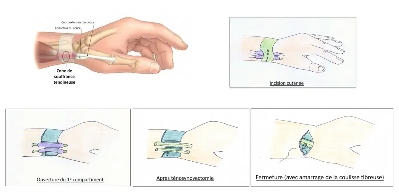 Schéma illustrant la zone de souffrance tendineuse au poignet, souvent liée à la tendinite du pouce, et les étapes chirurgicales d'une ténosynovectomie.
