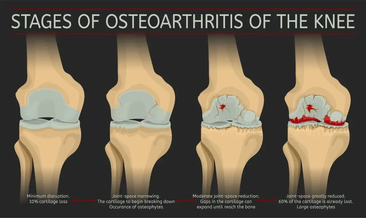 Illustration des stades de l'arthrose du genou, du stade 1 au stade 4, montrant la réduction de l'espace articulaire et la perte de cartilage. Le stade 4 représente un arthrose genou stade 4 avancé.