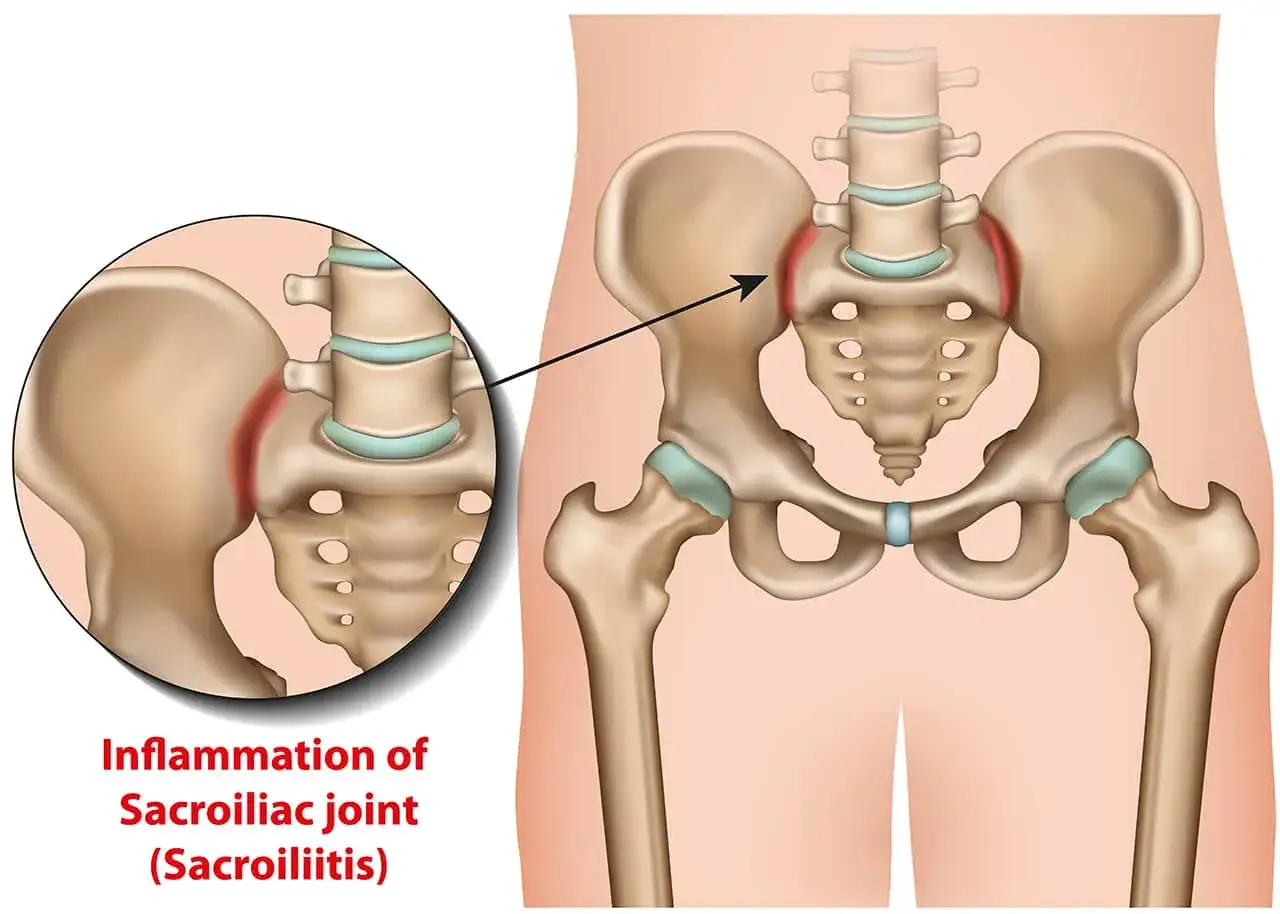 Illustration de l'inflammation de l'articulation sacro-iliaque gauche, expliquant la douleur fessier gauche signification.