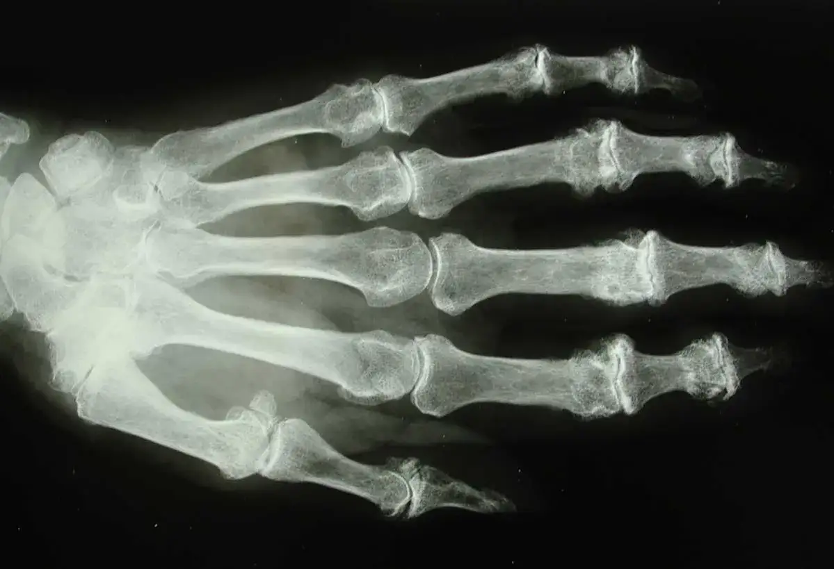 Radiographie d'une main montrant des signes d'arthrose du doigt chez un jeune patient, avec des déformations articulaires visibles.