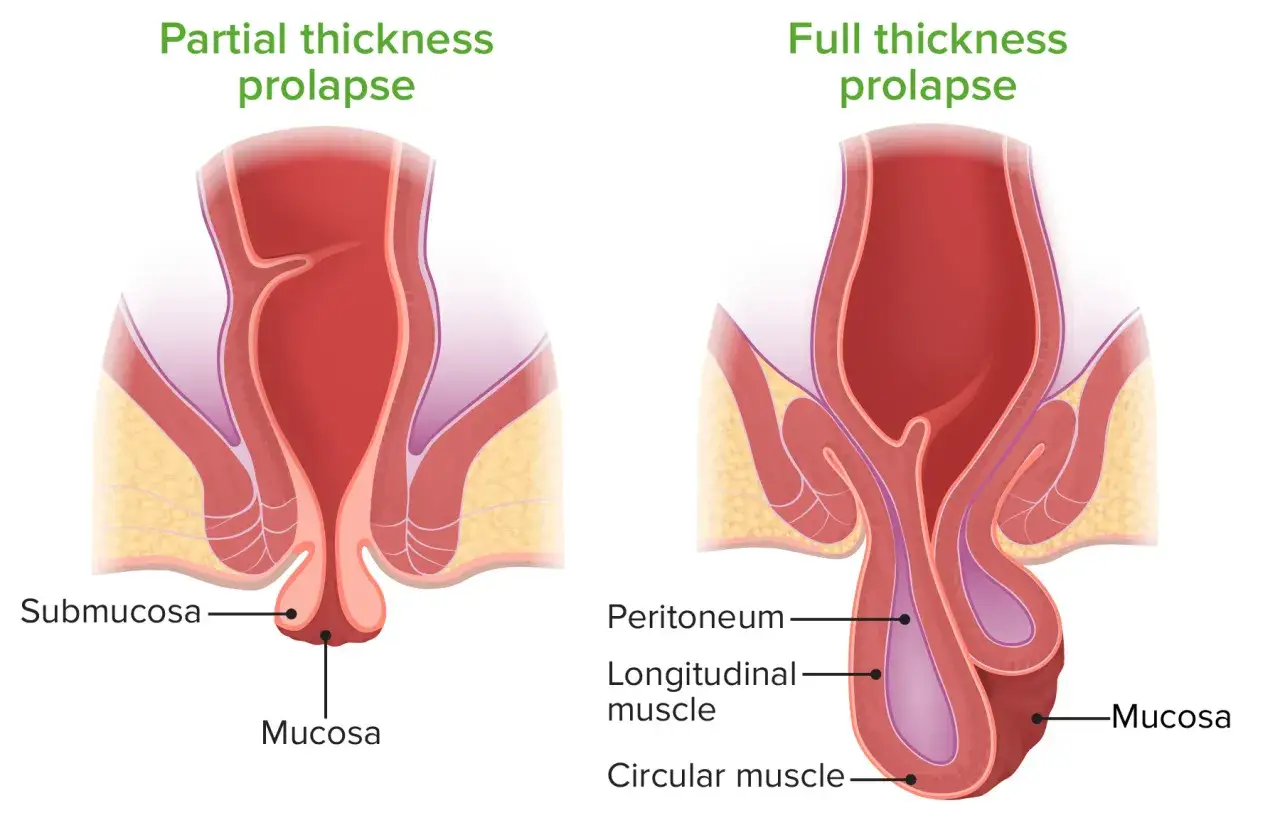 Illustration comparant un prolapsus partiel et un prolapsus complet d'organe chez l'homme, montrant l'affaissement des tissus.
