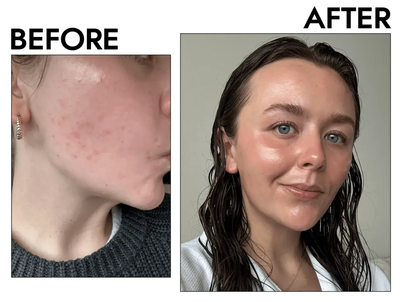 Avant/apr&egrave;s : peau avec imperfections avant, puis peau radieuse et lisse apr&egrave;s, peut-&ecirc;tre gr&acirc;ce &agrave; la vitamine A pour la peau.