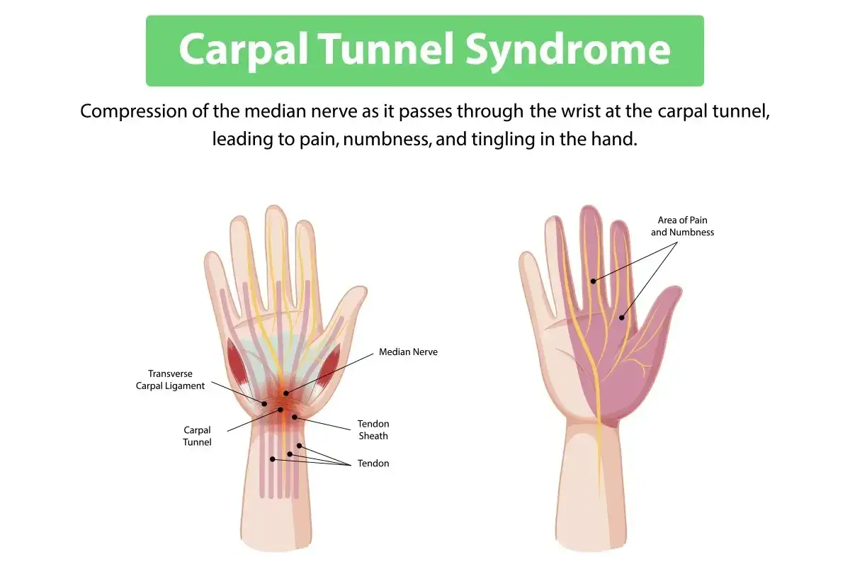 Illustration du syndrome du canal carpien, montrant la compression du nerf médian au poignet, cause de douleur main droite, engourdissement et picotements.