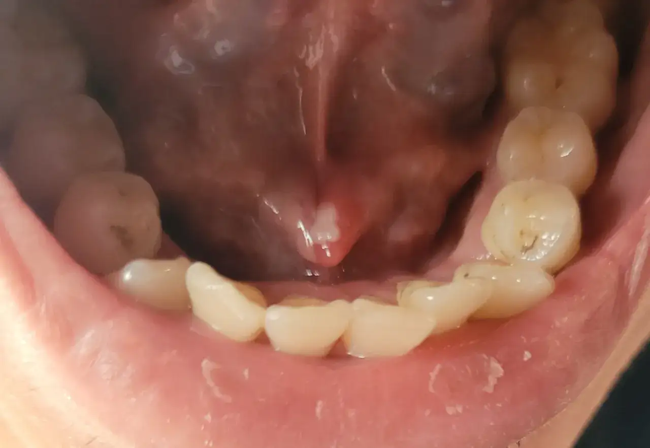 Un petit bouton blanc est visible sous la langue, près de la base. Les dents du bas sont également visibles.