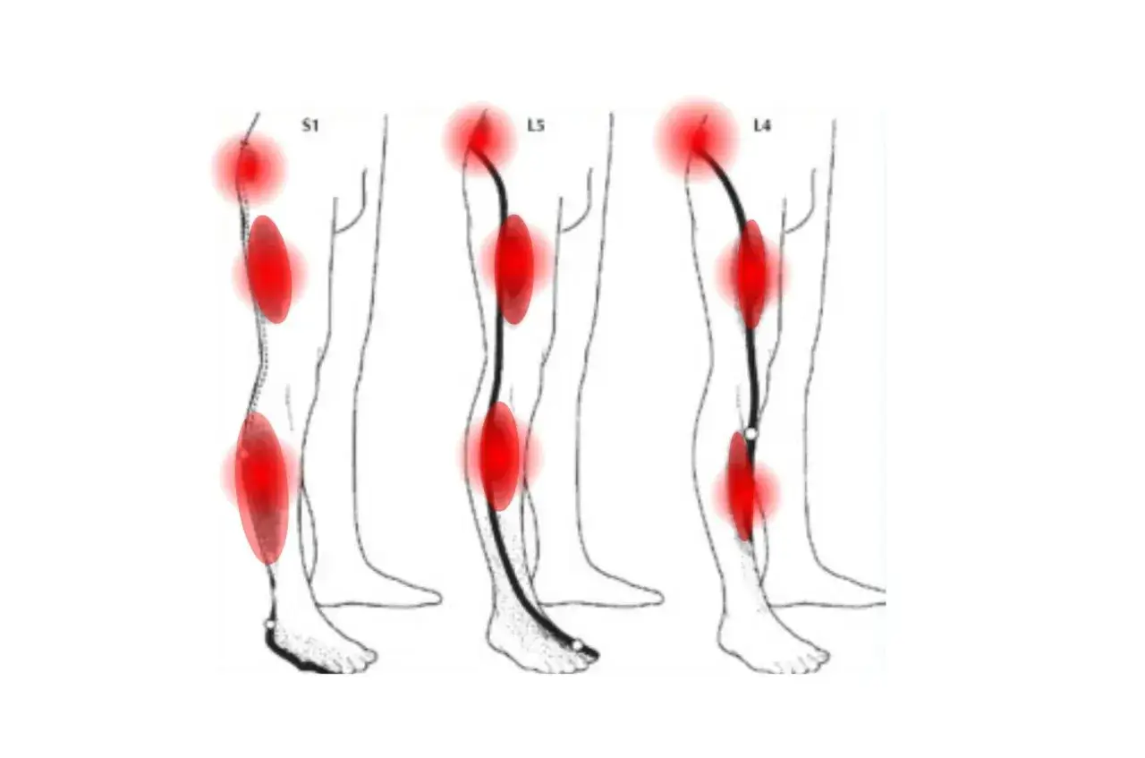 Schéma montrant les zones de douleur typiques d'une sciatique jambe droite, avec des points rouges indiquant les symptômes.