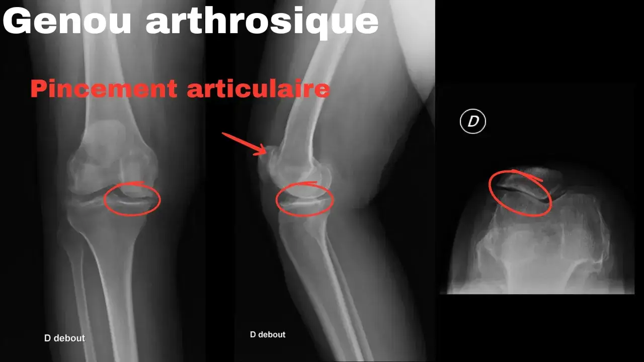 Radiographies du genou montrant un pincement articulaire, un symptôme clé de l'arthrose du genou.