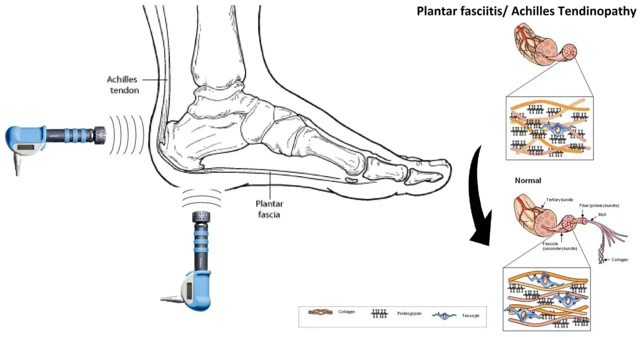 Appareil émettant des ondes de choc radiales pour traiter le tendon d'Achille et la fasciite plantaire. Illustration anatomique.