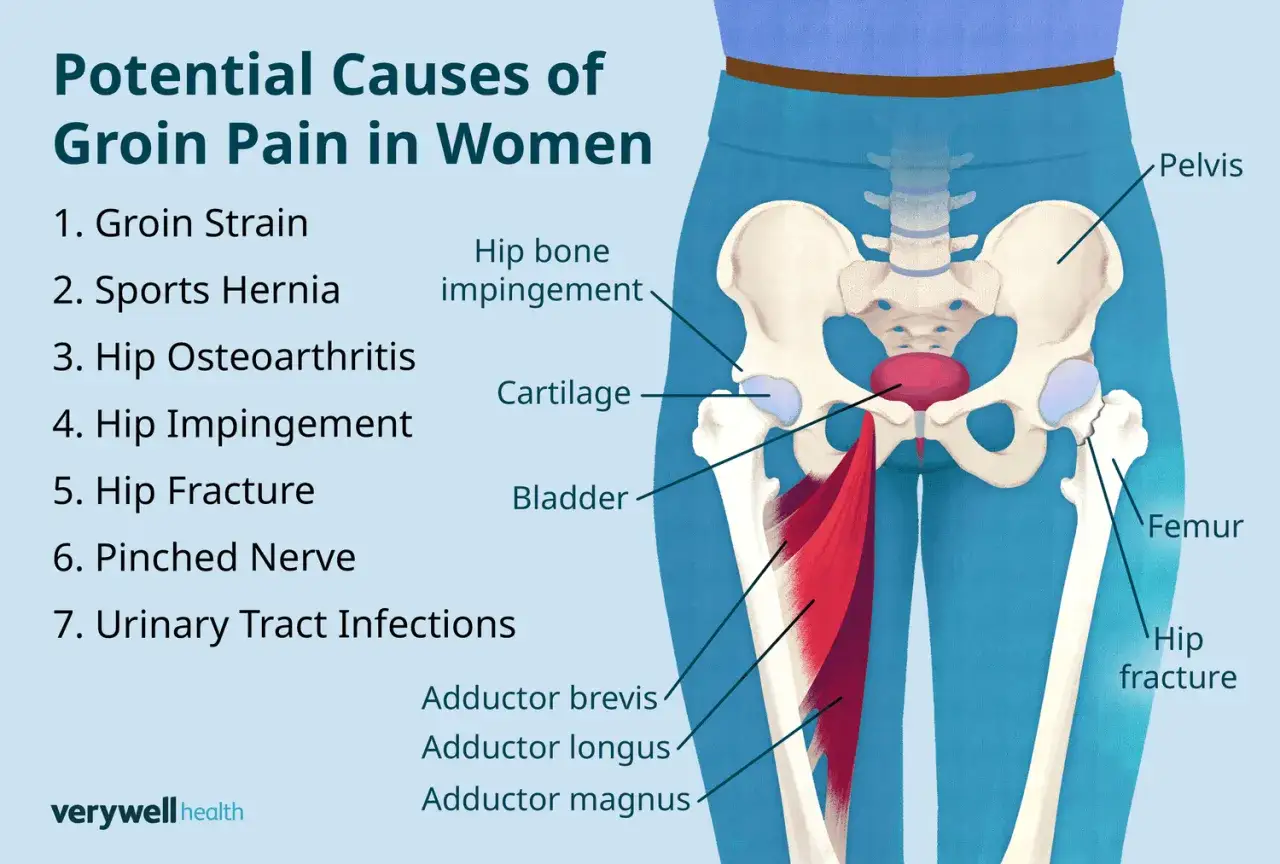 Anatomie féminine montrant où se situe l'aine, avec les causes potentielles de douleur : foulure, hernie, arthrose, fracture, etc.