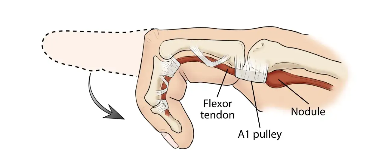 Illustration anatomique montrant un nodule sur le tendon fléchisseur, cause potentielle de douleur au doigt majeur gauche lors du mouvement.