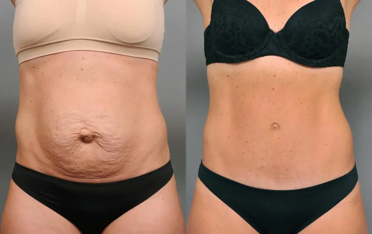 Diastasis avant après sans chirurgie : abdomen relâché et distendu avant, ventre tonique et plat après.