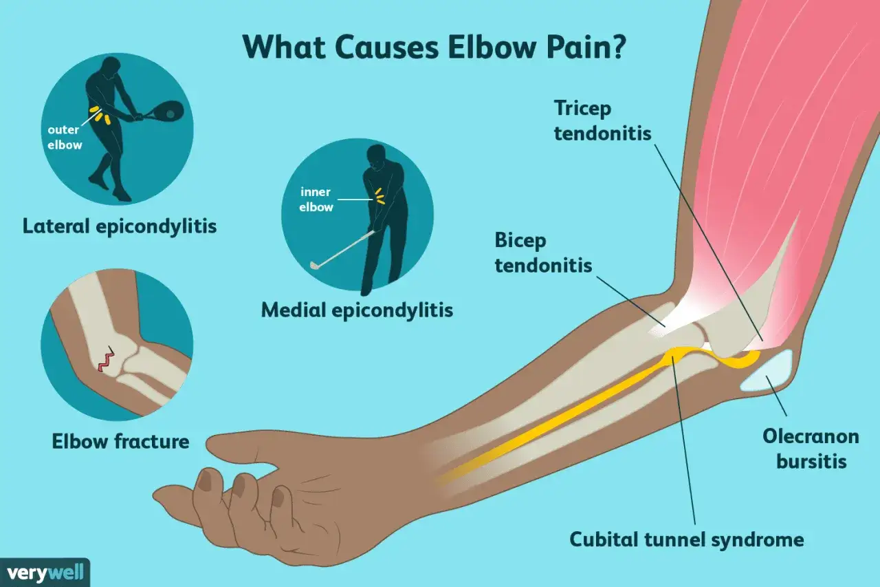 Causes de mal au coude droit : épicondylite latérale (tennis), médiale (golf), fracture, tendinites, bursite olécranienne, syndrome du tunnel cubital.