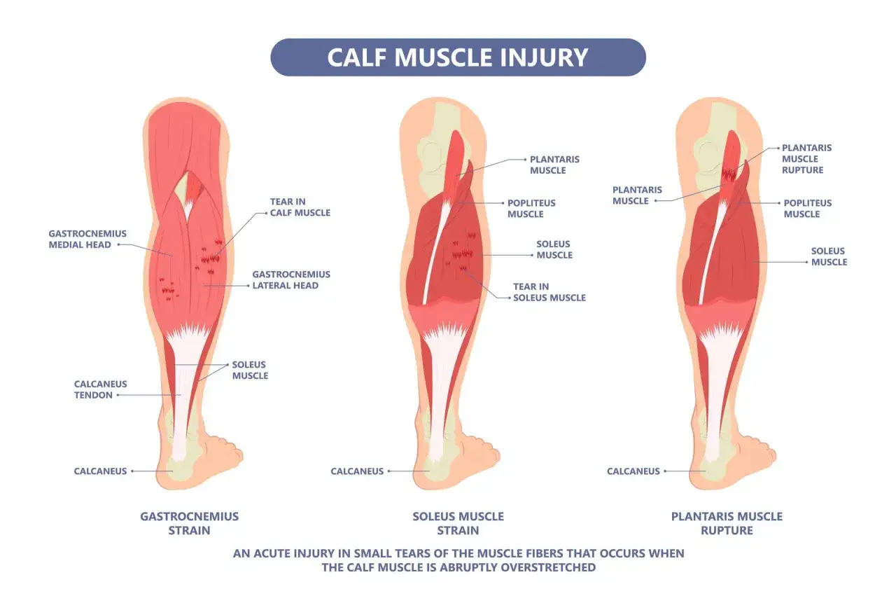 Anatomie du mollet droit montrant diverses blessures musculaires, dont une déchirure du mollet et une rupture du muscle plantaire, causant une douleur au mollet droit.