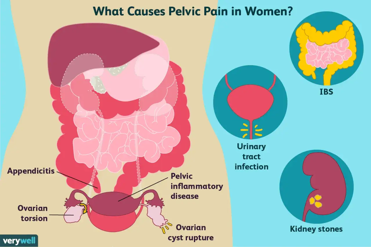 Schéma des causes du mal au bassin chez la femme : appendicite, torsion ovarienne, infection, maladie inflammatoire pelvienne, rupture de kyste, IBS, calculs rénaux.