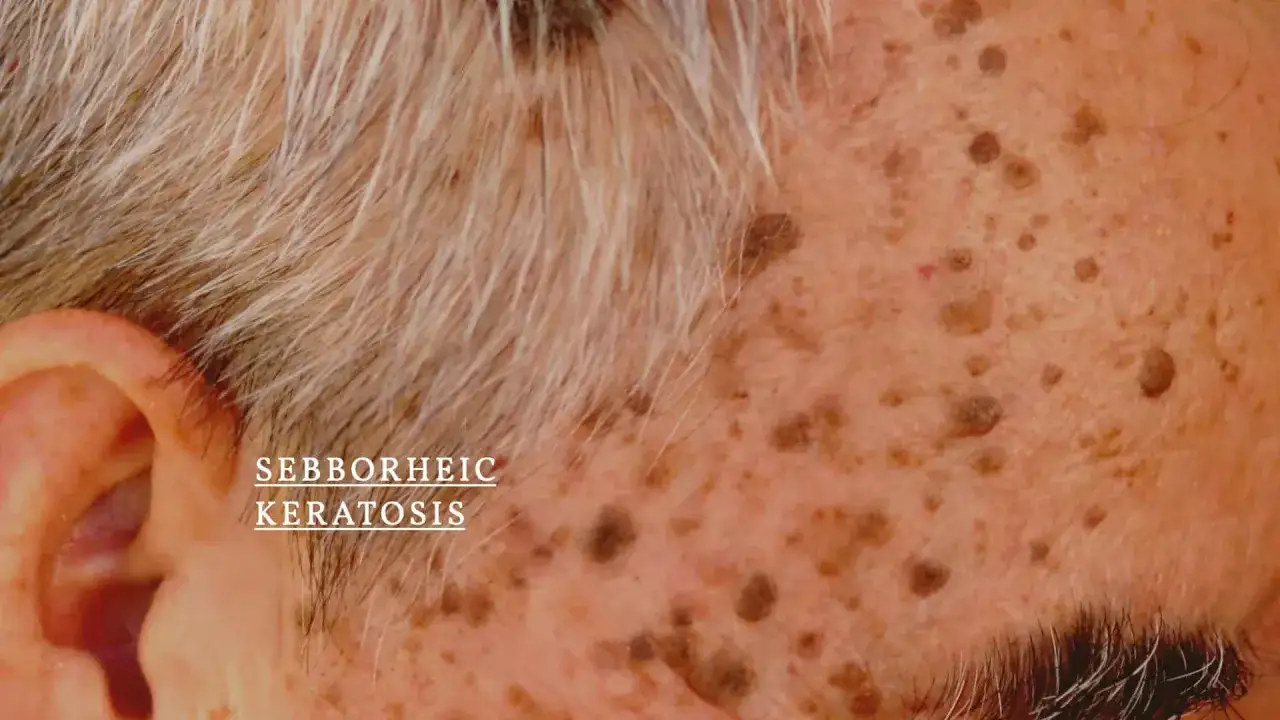 Gros plan sur le visage d'une personne âgée montrant des kératoses séborrhéiques. Recherche d'un traitement naturel pour ces lésions cutanées.