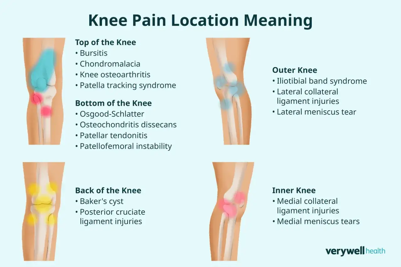 Schéma du genou montrant les causes de douleur interne : blessures ligamentaires médiales et déchirures du ménisque médial.