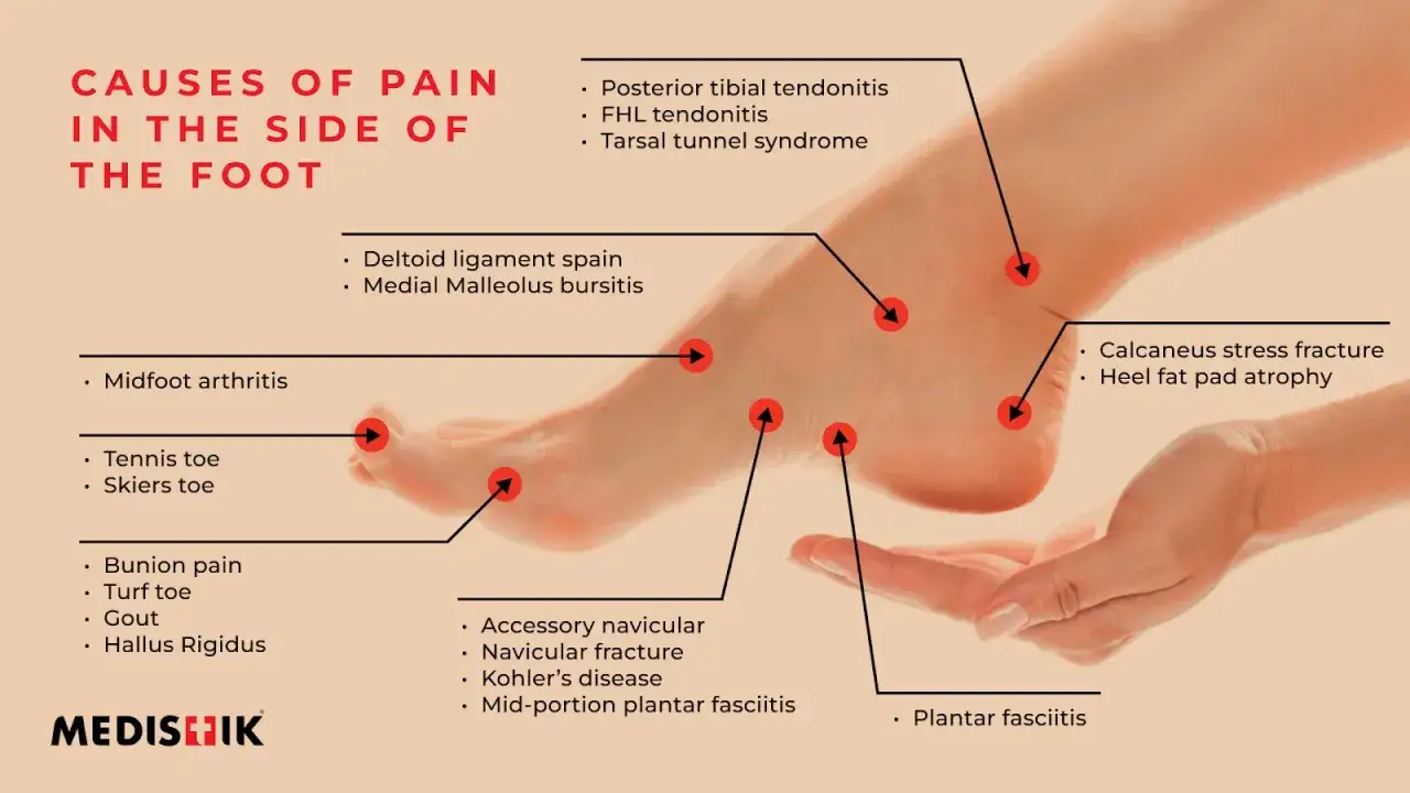 Causes de douleurs aux pieds lors de la marche : tendinite, arthrite, fracture, etc. Image illustrant les points de douleur.