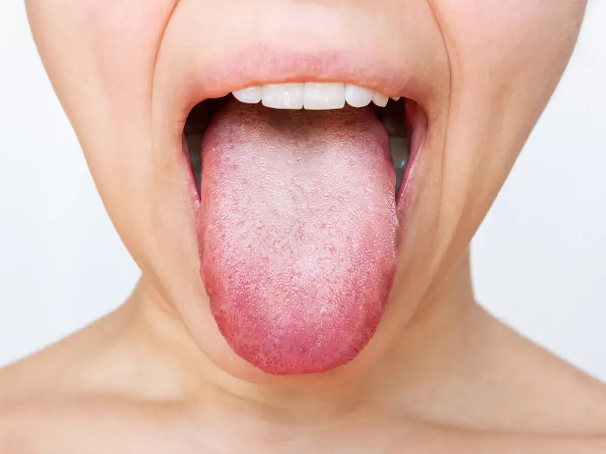 Une langue blanche, signe possible de stress, est montrée dans une bouche ouverte.