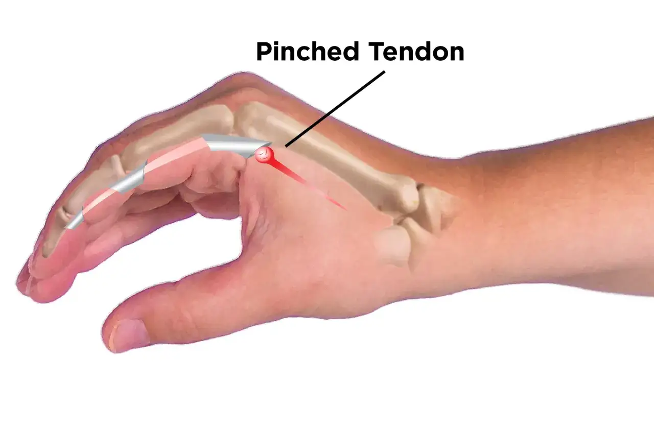 Illustration montrant une douleur à l'index gauche due à un tendon pincé, avec une zone rouge indiquant l'inflammation.