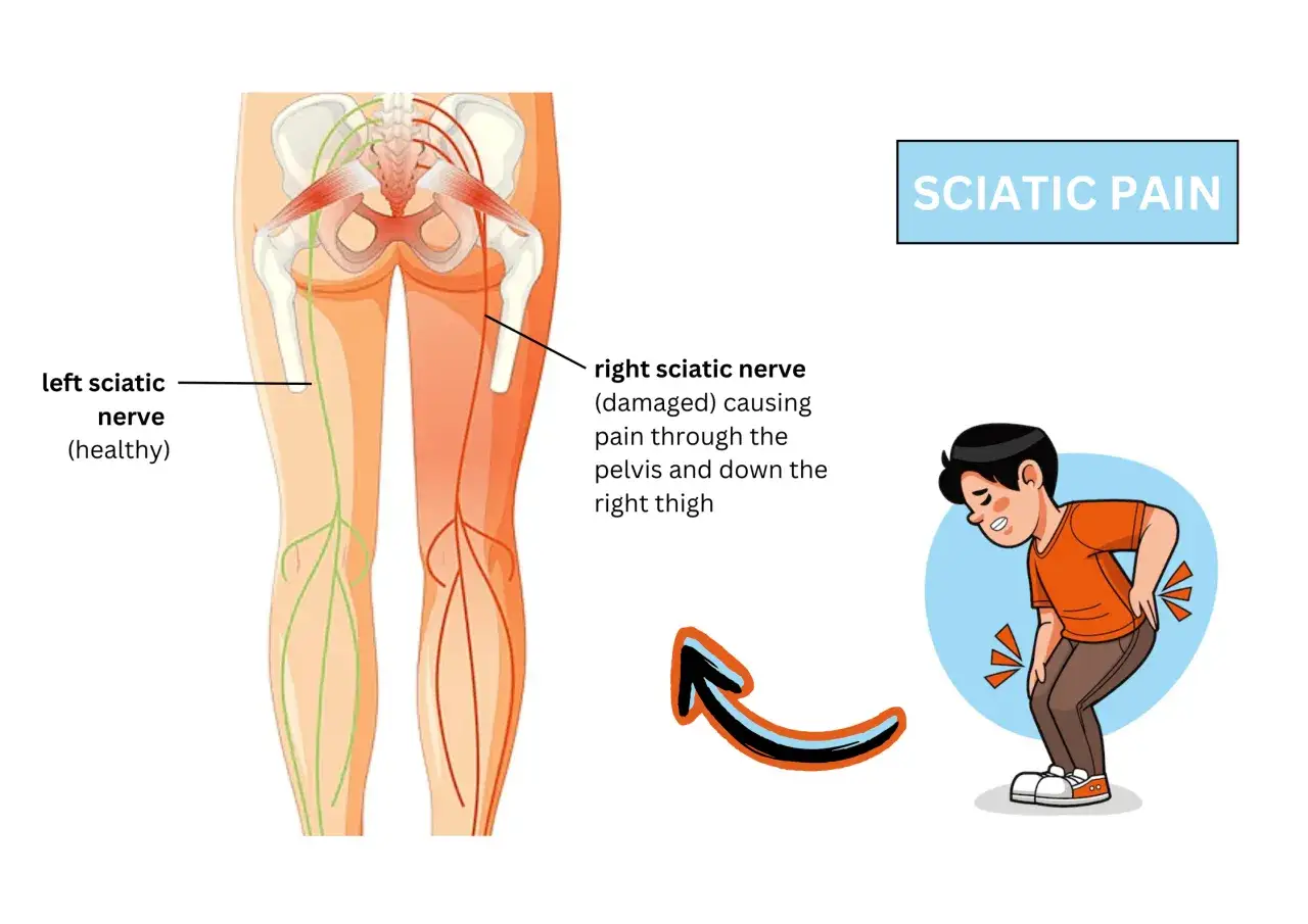 Anatomie montrant le nerf sciatique gauche sain et le nerf sciatique droit endommagé causant une douleur jambe gauche. Un homme se tient le bas du dos.