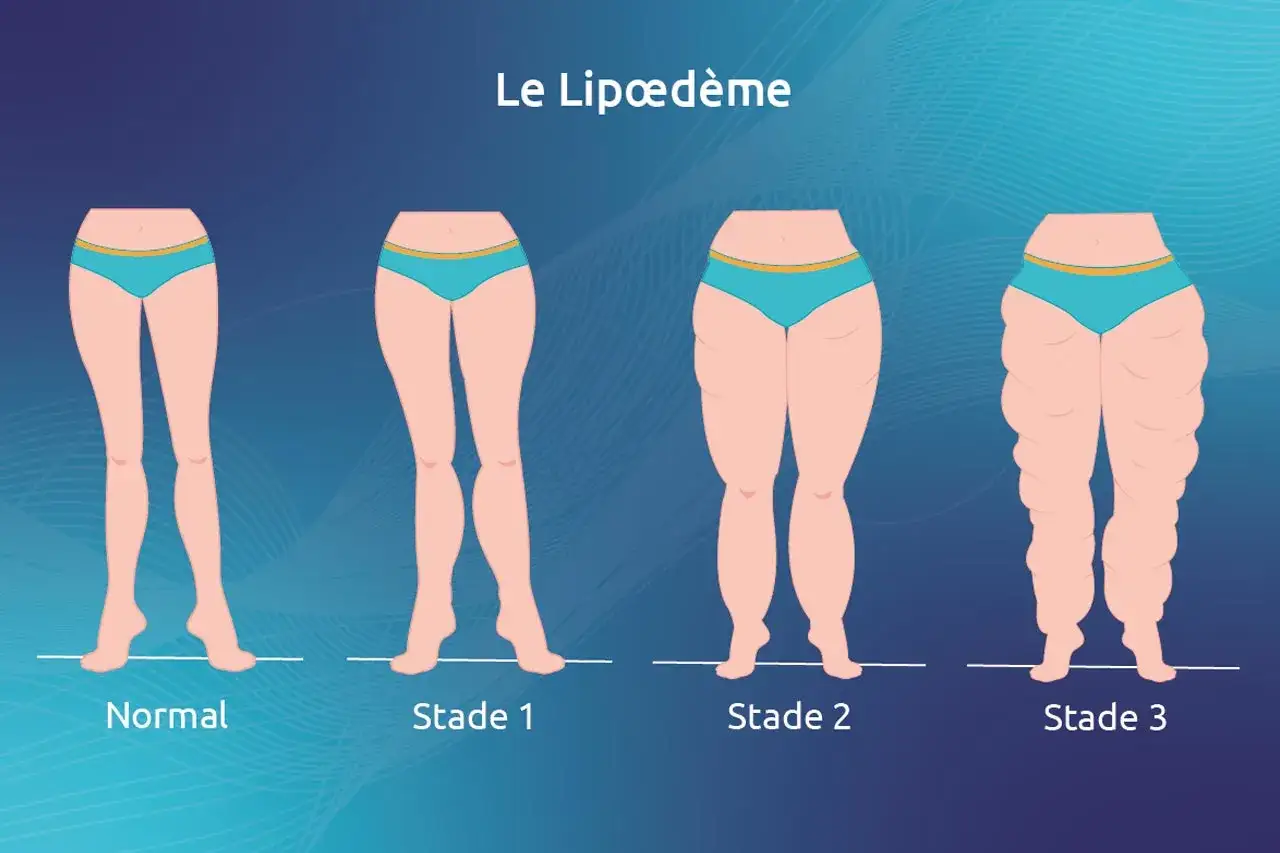 Illustration des stades du lipœdème, de normal à sévère. Des options de lipœdème traitement naturel peuvent aider.
