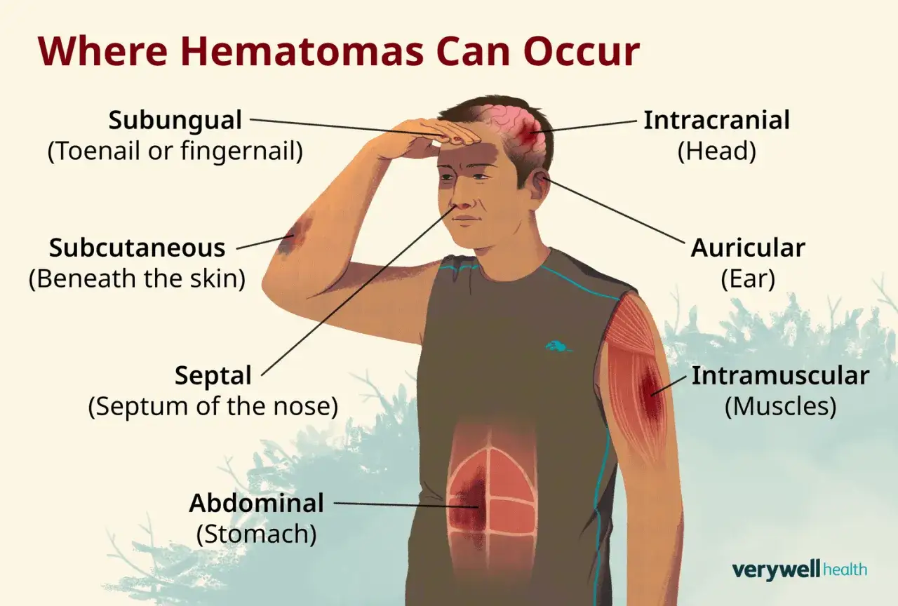 Illustration montrant où les hématomes peuvent survenir, y compris un hématome sous-cutané, intramusculaire, et une boule dure dans la tête.