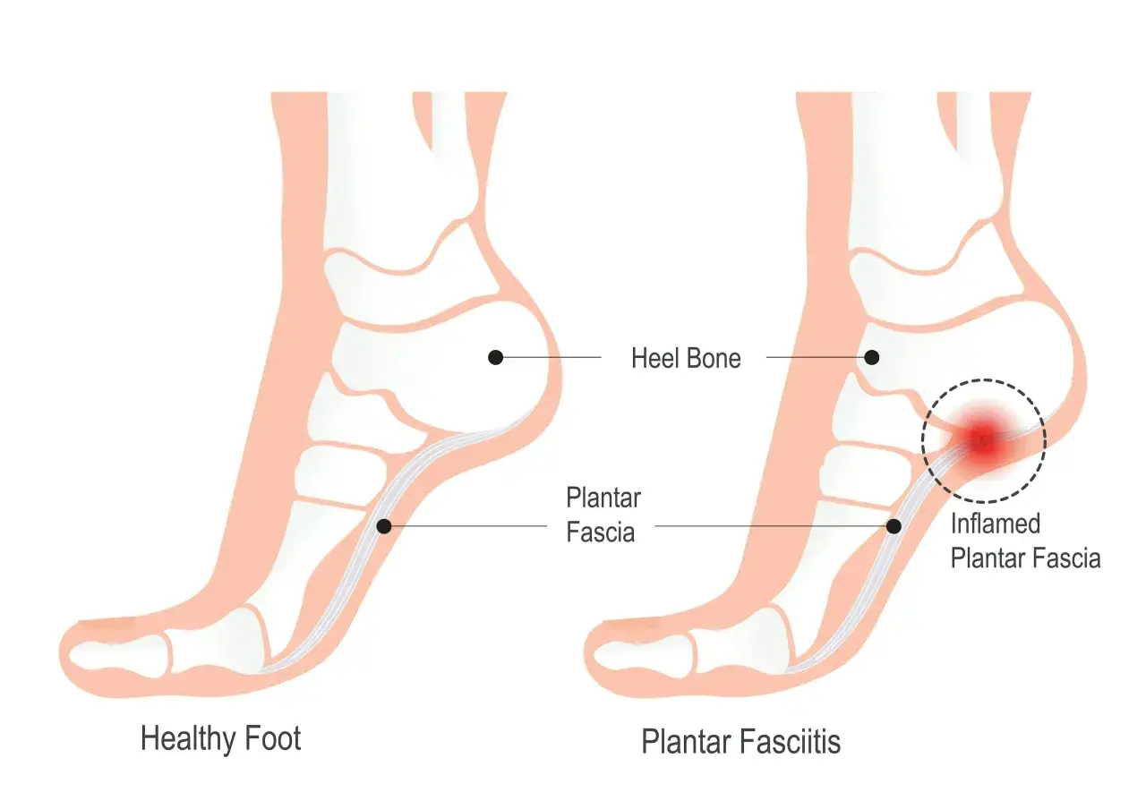 Comparaison d'un pied sain et d'un pied atteint de fasciite plantaire, montrant l'inflammation causant la douleur creux du pied.