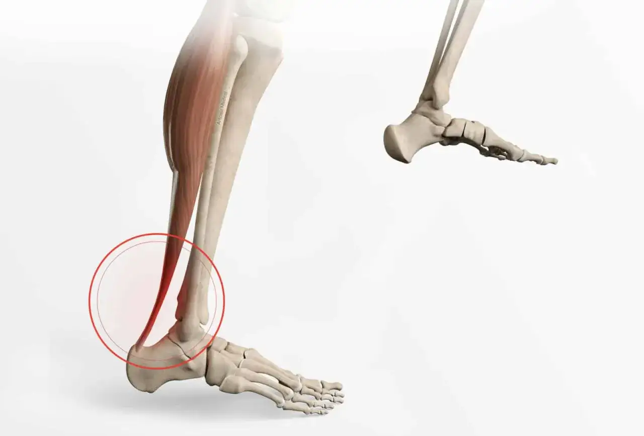 Anatomie du mollet et du pied, avec une zone rouge indiquant une douleur coté mollet.