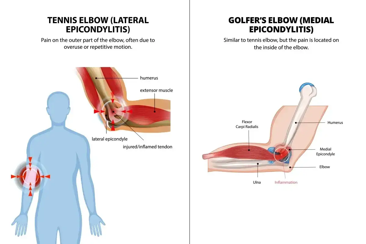 Illustration comparant le tennis elbow (douleur avant-bras extérieur) et le golfeur's elbow, montrant l'inflammation des tendons au niveau du coude.