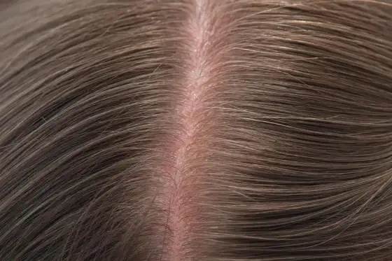 Cuir chevelu qui gratte - les gestes naturels qui apaisent