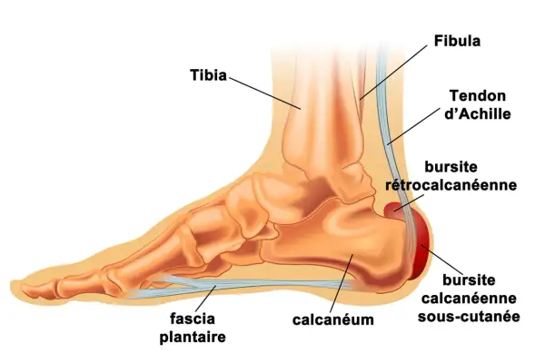 Anatomie du pied montrant le calcanéum, le fascia plantaire et le tendon d'Achille. Une bursite rétrocalcanéenne peut causer une tendinite sous le talon.