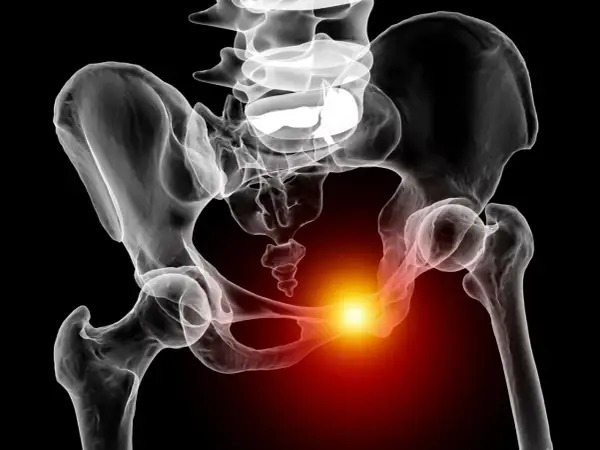Radiographie du bassin humain montrant une zone de douleur vive au niveau de la symphyse pubienne, suggérant une douleur symphyse pubienne sans grossesse.