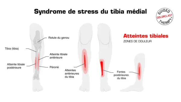 Schéma illustrant le syndrome de stress du tibia médial, avec des zones de douleur indiquées sur le tibia, pouvant signaler une fracture de fatigue tibia.