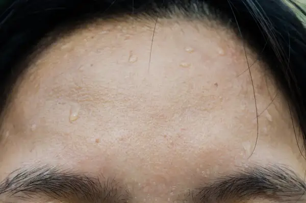 Gouttes de sueur sur le front, signe de transpiration excessive du visage.