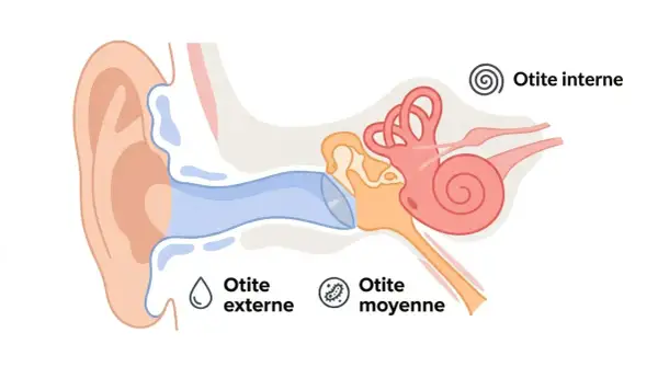 Schéma de l'oreille montrant otite externe, moyenne et interne. Des remèdes naturels pour l'otite peuvent aider.