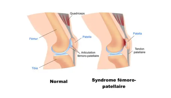 Comparaison d'un genou normal et d'un genou atteint du syndrome fémoro-patellaire, expliquant la douleur genou en descente.