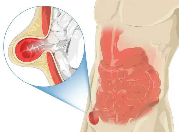 Illustration d'une hernie inguinale, montrant l'intestin sortant par une faiblesse de la paroi abdominale. Le pubis gonflé est une cause de douleur.